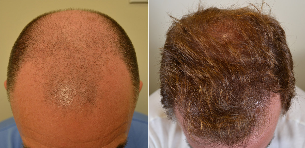 Follicular Unit Extraction – Fue Hair Transplant Surgery