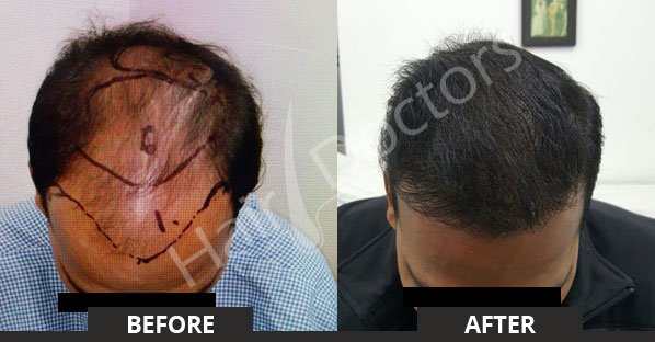 is hair transplant is permanent?