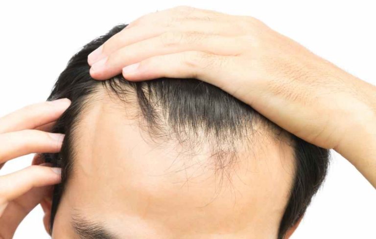 how-bad-nutrition-affects-and-can-be-cause-for-your-hair-loss