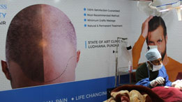Hair Transplant in Patiala