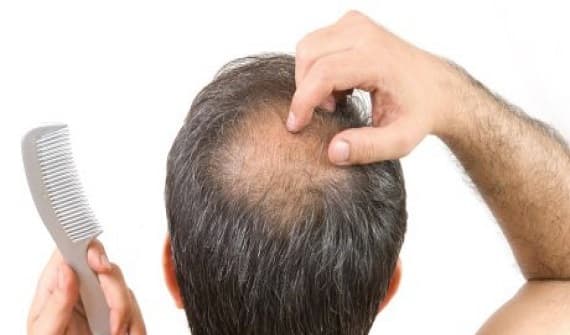 Hair Loss Patient at Hyderabad clinic