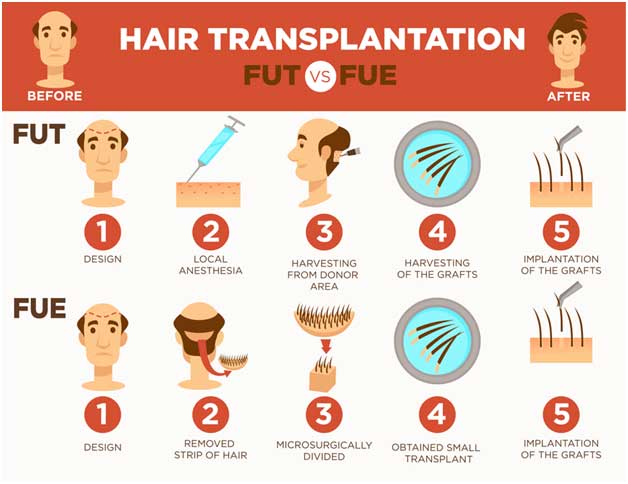 Best Hair Transplant Clinic in Nagpur - Hair Restoration Treatment