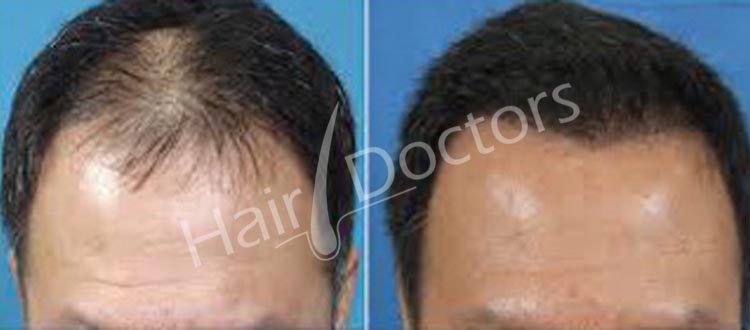 Hair Transplant in Gonda  Hair Transplant cost in Gonda