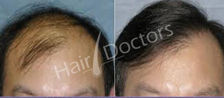 Best Hair Transplant Clinic in Ranchi Jharkhand  DermaClinix