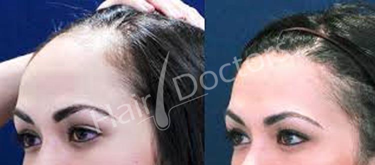 Hair Loss Treatment In Deputy Para Ranchi  View Cost Book Appointment  Online  Practo